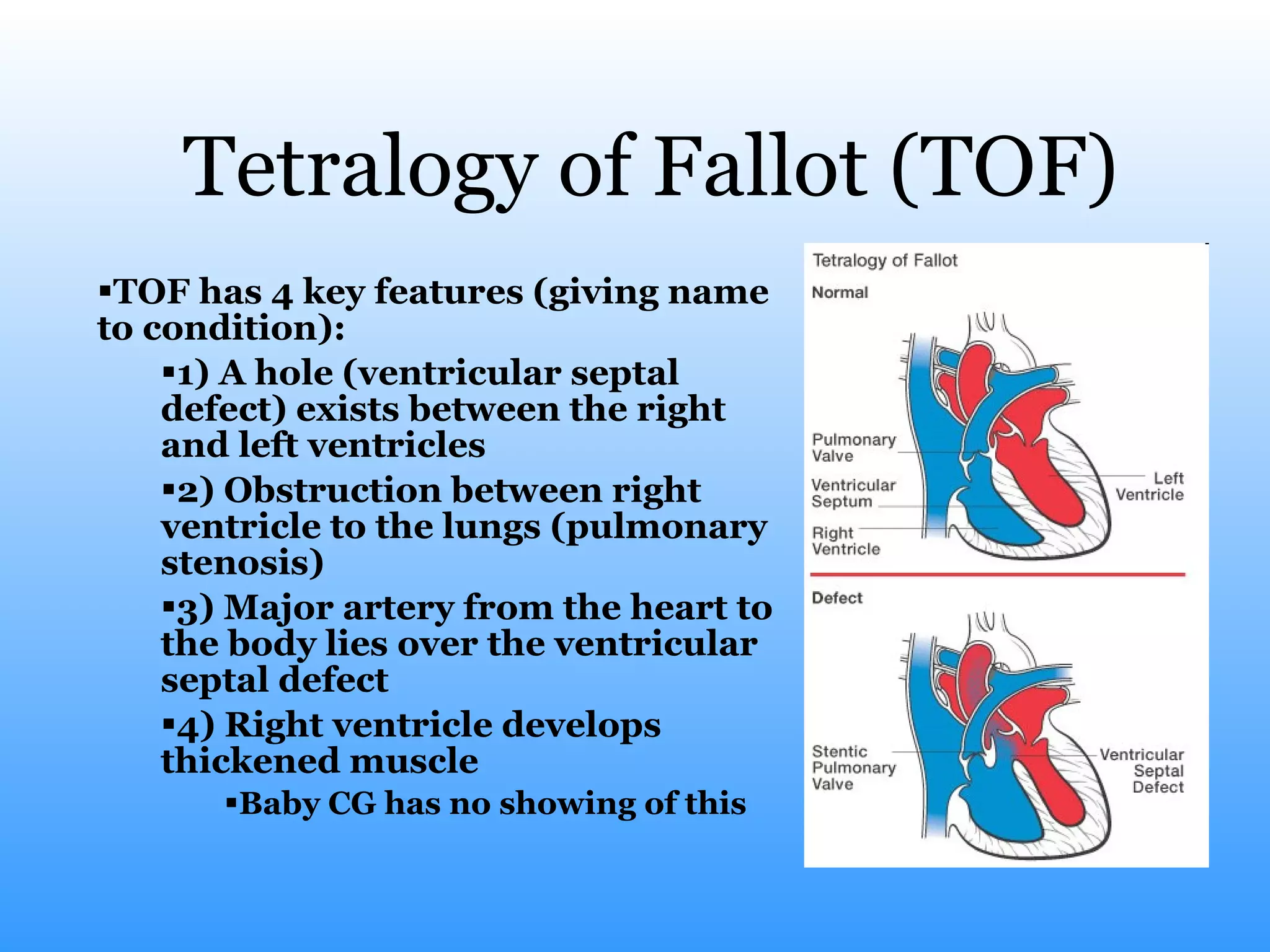 Tetralogy of Fallot (TOF) TOF has 4 key features (giving name to condition): 1) A hole (ventricular septal defect) exists between the right and left ventricles 2) Obstruction between right ventricle to the lungs (pulmonary stenosis) 3) Major artery from the heart to the body lies over the ventricular septal defect 4) Right ventricle develops thickened muscle Baby CG has no showing of this 