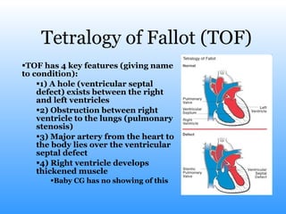 Tetralogy of Fallot (TOF) TOF has 4 key features (giving name to condition): 1) A hole (ventricular septal defect) exists between the right and left ventricles 2) Obstruction between right ventricle to the lungs (pulmonary stenosis) 3) Major artery from the heart to the body lies over the ventricular septal defect 4) Right ventricle develops thickened muscle Baby CG has no showing of this 