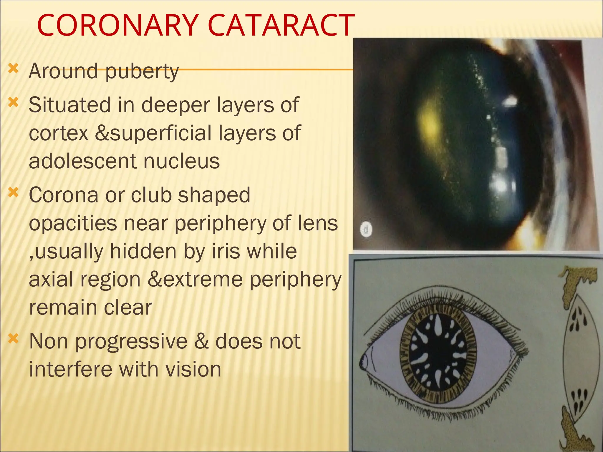 pediatric cataract-causes for not having vision | PPT