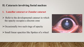 PEDIATRIC CATARACT & IT'S MANAGEMENT BY SAMIKSHA RAI | PDF