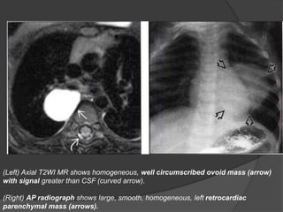 (Left) Axial T2WI MR shows homogeneous, well circumscribed ovoid mass (arrow)
with signal greater than CSF (curved arrow).
(Right) AP radiograph shows large, smooth, homogeneous, left retrocardiac
parenchymal mass (arrows).
 