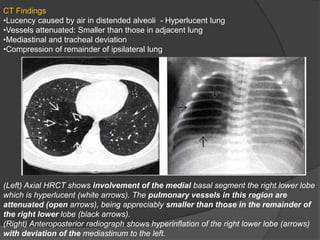 CT Findings
•Lucency caused by air in distended alveoli - Hyperlucent lung
•Vessels attenuated: Smaller than those in adjacent lung
•Mediastinal and tracheal deviation
•Compression of remainder of ipsilateral lung
(Left) Axial HRCT shows involvement of the medial basal segment the right lower lobe
which is hyperlucent (white arrows). The pulmonary vessels in this region are
attenuated (open arrows), being appreciably smaller than those in the remainder of
the right lower lobe (black arrows).
(Right) Anteroposterior radiograph shows hyperinflation of the right lower lobe (arrows)
with deviation of the mediastinum to the left.
 