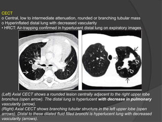 CECT
o Central, low to intermediate attenuation, rounded or branching tubular mass
o Hyperinflated distal lung with decreased vascularity
• HRCT: Air-trapping confirmed in hyperlucent distal lung on expiratory images.
(Left) Axial CECT shows a rounded lesion centrally adjacent to the right upper lobe
bronchus (open arrow). The distal lung is hyperlucent with decrease in pulmonary
vascularity (arrow).
(Right) Axial CECT shows branching tubular structure in the left upper lobe (open
arrows). Distal to these dilated fluid filled bronchi is hyperlucent lung with decreased
vascularity (arrows).
 