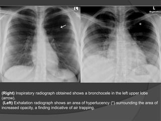 (Right) Inspiratory radiograph obtained shows a bronchocele in the left upper lobe
(arrow).
(Left) Exhalation radiograph shows an area of hyperlucency (*) surrounding the area of
increased opacity, a finding indicative of air trapping.
 