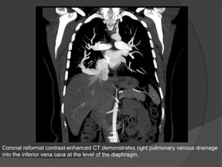 Coronal reformat contrast-enhanced CT demonstrates right pulmonary venous drainage
into the inferior vena cava at the level of the diaphragm.
 