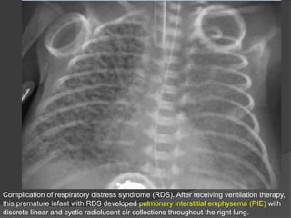 Complication of respiratory distress syndrome (RDS). After receiving ventilation therapy,
this premature infant with RDS developed pulmonary interstitial emphysema (PIE) with
discrete linear and cystic radiolucent air collections throughout the right lung.
 