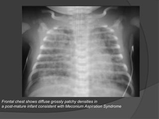 Frontal chest shows diffuse grossly patchy densities in
a post-mature infant consistent with Meconium Aspiration Syndrome
 