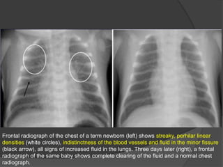 Frontal radiograph of the chest of a term newborn (left) shows streaky, perhilar linear
densities (white circles), indistinctness of the blood vessels and fluid in the minor fissure
(black arrow), all signs of increased fluid in the lungs. Three days later (right), a frontal
radiograph of the same baby shows complete clearing of the fluid and a normal chest
radiograph.
 