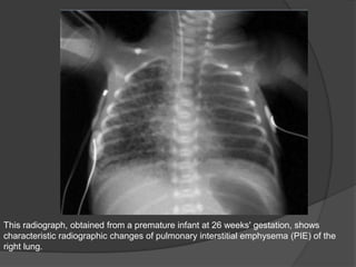 This radiograph, obtained from a premature infant at 26 weeks' gestation, shows
characteristic radiographic changes of pulmonary interstitial emphysema (PIE) of the
right lung.
 