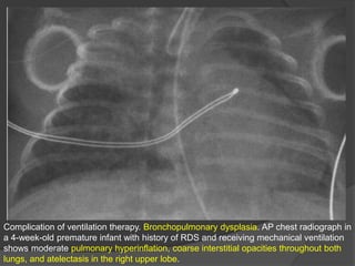 Complication of ventilation therapy. Bronchopulmonary dysplasia. AP chest radiograph in
a 4-week-old premature infant with history of RDS and receiving mechanical ventilation
shows moderate pulmonary hyperinflation, coarse interstitial opacities throughout both
lungs, and atelectasis in the right upper lobe.
 