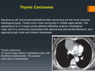 Thymic Carcinoma
Squamous cell and lymphoepithelioma-like carcinoma are the most common
histological types. These occur most commonly in middle-aged adults. The
appearance is of a large poorly defined infiltrative anterior mediastinal
mass and it is commonly associated with pleural and pericardial effusions, and
regional lymph node and distant metastasis.
Thymic carcinoma.
CT shows large anterior mediastinal mass with
ill-defined medial border. The superior
vena cava is compressed.
 