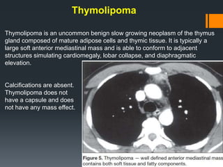 Thymolipoma
Thymolipoma is an uncommon benign slow growing neoplasm of the thymus
gland composed of mature adipose cells and thymic tissue. It is typically a
large soft anterior mediastinal mass and is able to conform to adjacent
structures simulating cardiomegaly, lobar collapse, and diaphragmatic
elevation.
Calcifications are absent.
Thymolipoma does not
have a capsule and does
not have any mass effect.
 