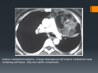 Anterior mediastinal teratoma - A large heterogenous left anterior mediastinal mass
containing soft tissue , fatty and calcific components.
 