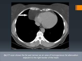 (b) CT scan shows the fat pad (arrow) as an area of homogeneous fat attenuation
adjacent to the right border of the heart.
 