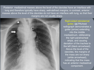 Right-sided retrosternal
goiter. (a) PAchest
radiograph demonstrates a
goiter (arrow) extending
into the middle
mediastinum, obliterating
the right paratracheal
stripe, and causing
deviation of the trachea to
the left (black arrowhead).
Above the level of the
clavicles, the margins of
the mass are not sharp
(white arrowhead),
indicating that the mass
has an anterior mediastinal
component.
Posterior mediastinal masses above the level of the clavicles have an interface with
lung and therefore typically have sharp, well-defined margins; in contrast, anterior
masses above the level of the clavicles do not have an interface with lung, so that their
margins are not usually sharp.
 