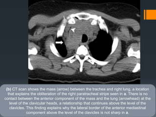 (b) CT scan shows the mass (arrow) between the trachea and right lung, a location
that explains the obliteration of the right paratracheal stripe seen in a. There is no
contact between the anterior component of the mass and the lung (arrowhead) at the
level of the clavicular heads, a relationship that continues above the level of the
clavicles. This finding explains why the lateral border of the anterior mediastinal
component above the level of the clavicles is not sharp in a.
 