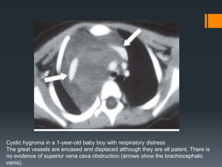Cystic hygroma in a 1-year-old baby boy with respiratory distress
The great vessels are encased and displaced although they are all patent. There is
no evidence of superior vena cava obstruction (arrows show the brachiocephalic
veins).
 