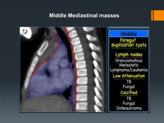 .
Middle Mediastinal masses
 