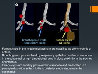 Foregut cysts in the middle mediastinum are classified as bronchogenic or
enteric.
Bronchogenic cysts are lined by respiratory epithelium and most are located
in the subcarinal or right paratracheal area in close proximity to the trachea
or bronchus.
Enteric cysts are lined by gastrointestinal mucosa and are located in a
paraspinal position in the middle to posterior mediastinum near the
esophagus
 