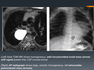 (Left) Axial T2WI MR shows homogeneous, well circumscribed ovoid mass (arrow)
with signal greater than CSF (curved arrow).
(Right) AP radiograph shows large, smooth, homogeneous, left retrocardiac
parenchymal mass (arrows).
 