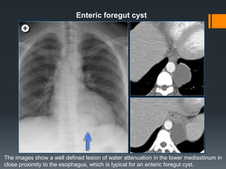Enteric foregut cyst
The images show a well defined lesion of water attenuation in the lower mediastinum in
close proximity to the esophagus, which is typical for an enteric foregut cyst.
 