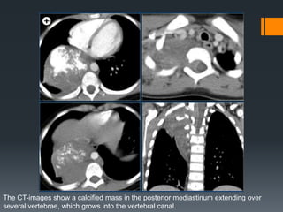 The CT-images show a calcified mass in the posterior mediastinum extending over
several vertebrae, which grows into the vertebral canal.
 