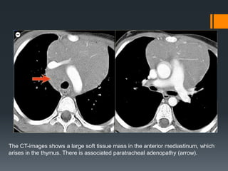 The CT-images shows a large soft tissue mass in the anterior mediastinum, which
arises in the thymus. There is associated paratracheal adenopathy (arrow).
 