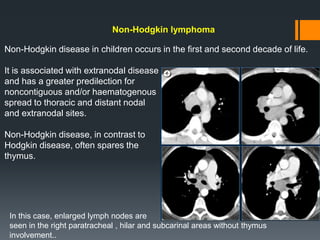 Non-Hodgkin lymphoma
Non-Hodgkin disease in children occurs in the first and second decade of life.
It is associated with extranodal disease
and has a greater predilection for
noncontiguous and/or haematogenous
spread to thoracic and distant nodal
and extranodal sites.
Non-Hodgkin disease, in contrast to
Hodgkin disease, often spares the
thymus.
In this case, enlarged lymph nodes are
seen in the right paratracheal , hilar and subcarinal areas without thymus
involvement..
 