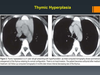 Thymic Hyperplasia
 