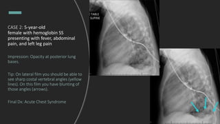 CASE 2: 5-year-old
female with hemoglobin SS
presenting with fever, abdominal
pain, and left leg pain
Impression: Opacity at posterior lung
bases.
Tip: On lateral film you should be able to
see sharp costal vertebral angles (yellow
lines). On this film you have blunting of
those angles (arrows).
Final Dx: Acute Chest Syndrome
 