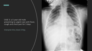 CASE 3: a 5-year-old male
presenting to urgent care with fever,
cough and chest pain for 3 days.
Interpret this chest X-Ray
 