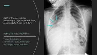 CASE 3: A 5-year-old male
presenting to urgent care with fever,
cough and chest pain for 3 days.
Right lower lobe pneumonia!
The patient is given
Amoxicillin - Clavulanate and
discharged home. But then...
 