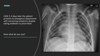 CASE 3: 4 days later the patient
presents to emergency department
with worsening symptoms despite
taking antibiotic as prescribed.
Now what do you see?
 