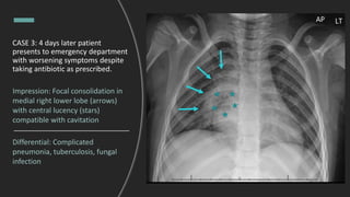 CASE 3: 4 days later patient
presents to emergency department
with worsening symptoms despite
taking antibiotic as prescribed.
Impression: Focal consolidation in
medial right lower lobe (arrows)
with central lucency (stars)
compatible with cavitation
Differential: Complicated
pneumonia, tuberculosis, fungal
infection
 