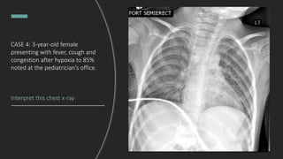 CASE 4: 3-year-old female
presenting with fever, cough and
congestion after hypoxia to 85%
noted at the pediatrician’s office.
Interpret this chest x-ray
 