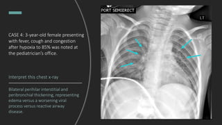 CASE 4: 3-year-old female presenting
with fever, cough and congestion
after hypoxia to 85% was noted at
the pediatrician’s office.
Interpret this chest x-ray
Bilateral perihilar interstitial and
peribronchial thickening, representing
edema versus a worsening viral
process versus reactive airway
disease.
 