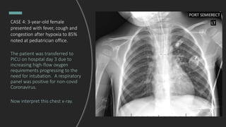CASE 4: 3-year-old female
presented with fever, cough and
congestion after hypoxia to 85%
noted at pediatrician office.
The patient was transferred to
PICU on hospital day 3 due to
increasing high-flow oxygen
requirements progressing to the
need for intubation. A respiratory
panel was positive for non-covid
Coronavirus.
Now interpret this chest x-ray.
 