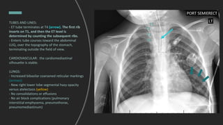 TUBES AND LINES:
- ET tube terminates at T4 (arrow). The first rib
inserts on T1, and then the ET level is
determined by counting the subsequent ribs.
- Enteric tube courses toward the abdominal
LUQ, over the topography of the stomach,
terminating outside the field of view.
CARDIOVASCULAR: the cardiomediastinal
silhouette is stable.
LUNGS:
- Increased bibasilar coarsened reticular markings
(arrows)
- New right lower lobe segmental hazy opacity
versus atelectasis (yellow)
- No consolidations or effusions
- No air block complications (pulmonary
interstitial emphysema, pneumothorax,
pneumomediastinum)
T1
T2
T3
T4
 