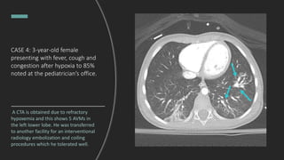 CASE 4: 3-year-old female
presenting with fever, cough and
congestion after hypoxia to 85%
noted at the pediatrician’s office.
A CTA is obtained due to refractory
hypoxemia and this shows 5 AVMs in
the left lower lobe. He was transferred
to another facility for an interventional
radiology embolization and coiling
procedures which he tolerated well.
 