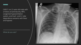 What do you see?
CASE 5: an 11-year-old male with
a history of prematurity, BPD,
congenital hypoventilation
system, and trach- and G- tube
dependence presents with fever
and hypoxia.
 