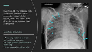 Multifocal pneumonia
- Worsening moderate to severe
hazy and linear opacity in
the lungs, greatest in right mid and
upper lung
- Lesser opacity in left lower lobe
CASE 5: an 11-year-old male with
a history of prematurity, BPD,
congenital hypoventilation
system, and trach- and G- tube
dependence presents with fever
and hypoxia.
 