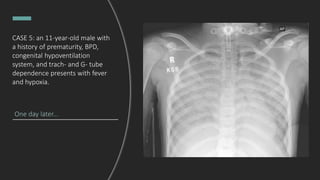 One day later...
CASE 5: an 11-year-old male with
a history of prematurity, BPD,
congenital hypoventilation
system, and trach- and G- tube
dependence presents with fever
and hypoxia.
 
