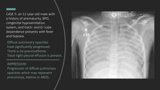 IMPRESSION:
Progression of diffuse pulmonary
opacities which may represent
pneumonia, edema or ARDS.
Diffuse pulmonary opacities
have significantly progressed.
There is no pneumothorax.
Trace right pleural effusion is present.
CASE 5: an 11-year-old male with
a history of prematurity, BPD,
congenital hypoventilation
system, and trach- and G- tube
dependence presents with fever
and hypoxia.
 