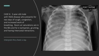 CASE 6: 3-year-old male
with HbSS disease who presents for
two days of cough, congestion,
and increased work of
breathing. Room air saturations are in
the 80s and he is tachypneic, grunting,
and having intercostal retractions.
Interpret this chest x-ray.
 