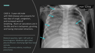Bilateral opacities, right > left with air
bronchograms. Moderate right sided
pleural effusion. Overlying high flow nasal
cannula.
DDx: pulmonary edema, multifocal
pneumonia
CASE 6: 3-year-old male
with HbSS disease who presents for
two days of cough, congestion,
and increased work of
breathing. Room air saturations are in
the 80s and he is tachypneic, grunting,
and having intercostal retractions.
 