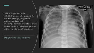 Final Dx: Acute chest syndrome
CASE 6: 3-year-old male
with HbSS disease who presents for
two days of cough, congestion,
and increased work of
breathing. Room air saturations are in
the 80s and he is tachypneic, grunting,
and having intercostal retractions.
 