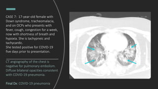 CT angiography of the chest is
negative for pulmonary embolism.
Diffuse bilateral opacities consistent
with COVID-19 pneumonia.
Final Dx: COVID-19 pneumonia
CASE 7: 17-year-old female with
Down syndrome, tracheomalacia,
and on OCPs who presents with
fever, cough, congestion for a week,
now with shortness of breath and
hypoxia. She is tachypneic and
tachycardic.
She tested positive for COVID-19
five days prior to presentation.
 