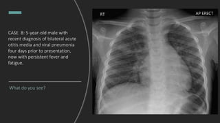 CASE 8: 5-year-old male with
recent diagnosis of bilateral acute
otitis media and viral pneumonia
four days prior to presentation,
now with persistent fever and
fatigue.
What do you see?
 