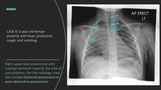 CASE 9: 3-year-old female
presents with fever, productive
cough, and vomiting.
Right upper lobe pneumonia with
tracheal deviation towards the area of
consolidation. Per the radiology read,
ddx includes bacterial pneumonia or
post-obstructive pneumonia.
 