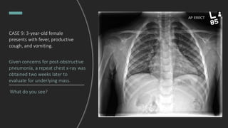 CASE 9: 3-year-old female
presents with fever, productive
cough, and vomiting.
Given concerns for post-obstructive
pneumonia, a repeat chest x-ray was
obtained two weeks later to
evaluate for underlying mass.
What do you see?
 